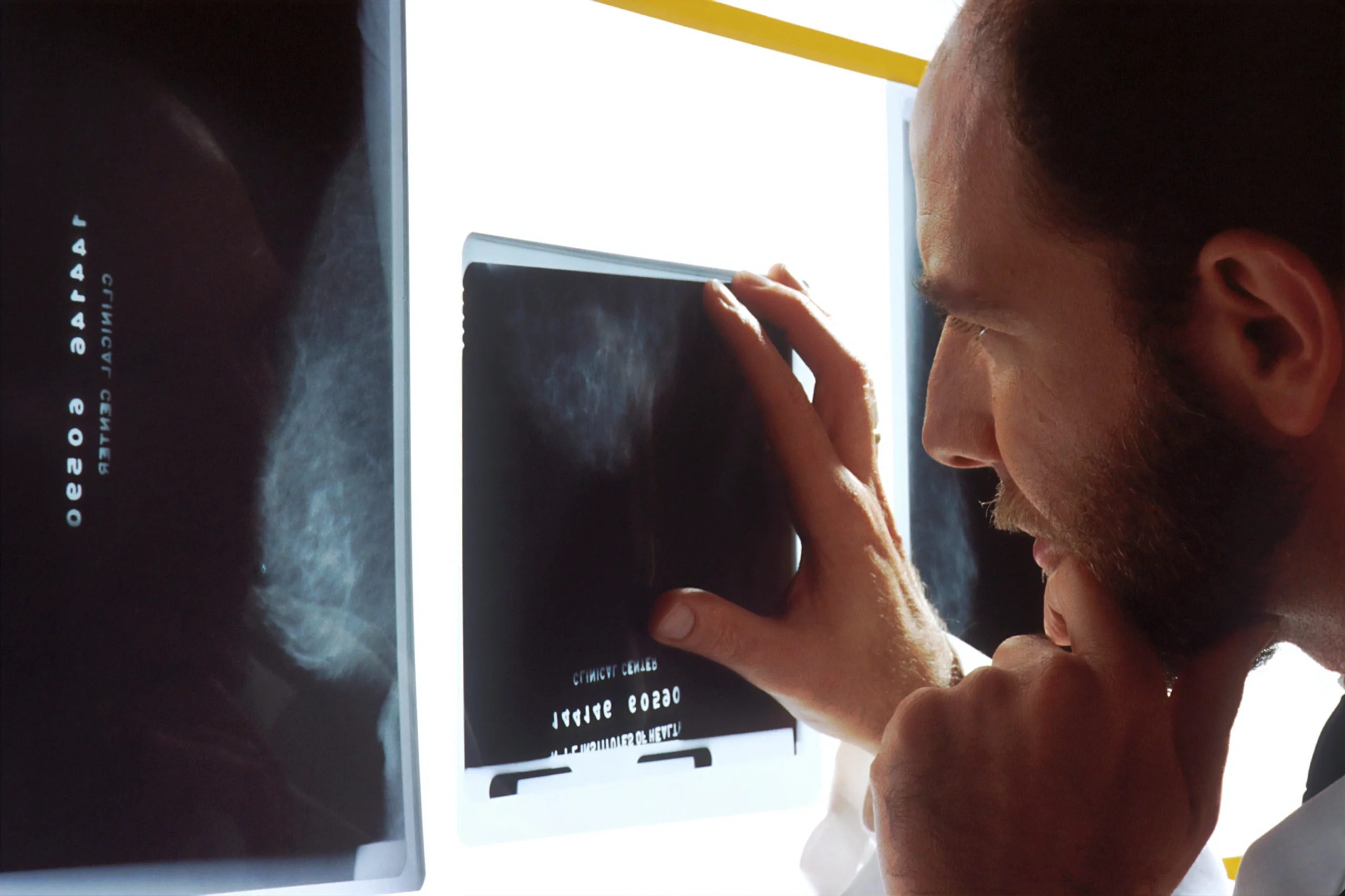 How Much Does a Mammogram Cost Without Insurance?